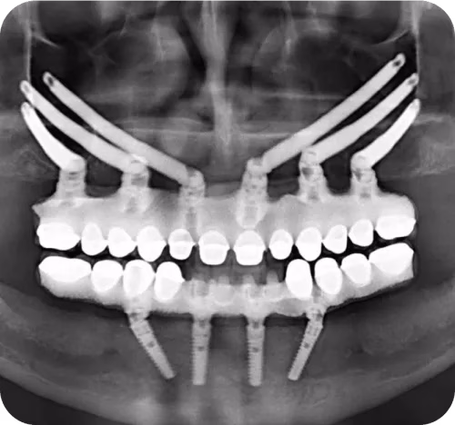 Zygomatic Dental Implants